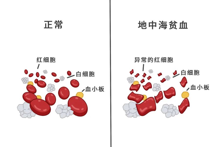 地中海贫血试管婴儿