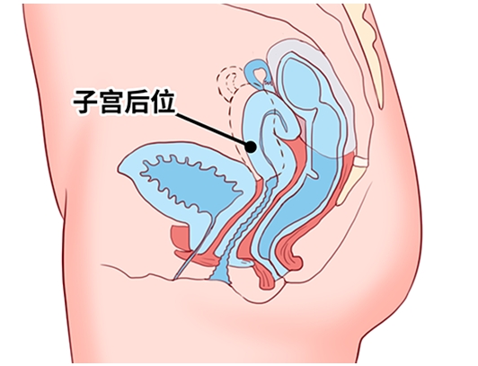 子宫前位是好事还是坏事 子宫前位是易孕体质吗