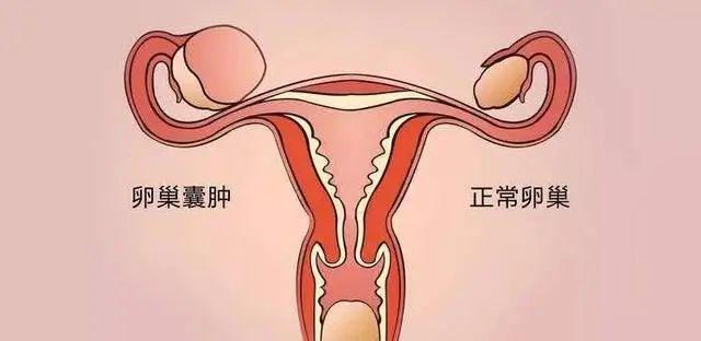 卵巢囊肿做试管婴儿能实现生育吗？成功几率多大？