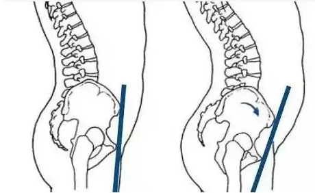 骨盆前倾有什么办法可以进行矫正吗？