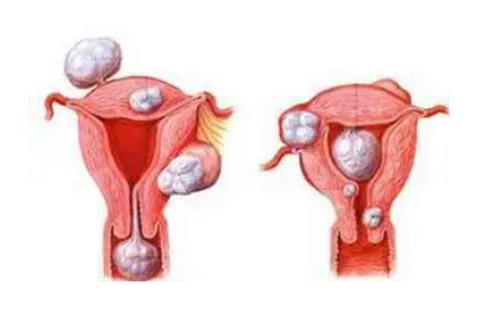 子宫肌瘤不做手术治疗会变得不孕不育吗？