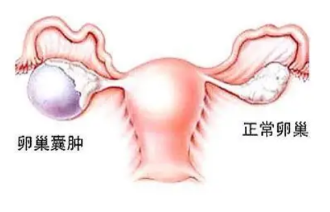 卵巢囊肿分几类，不是所有的卵巢囊肿都需要手术治疗