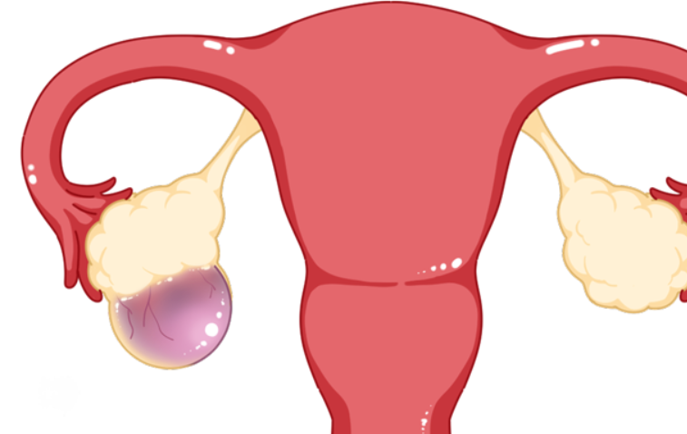卵巢囊肿一般不影响怀孕，有效治疗可提高受孕率