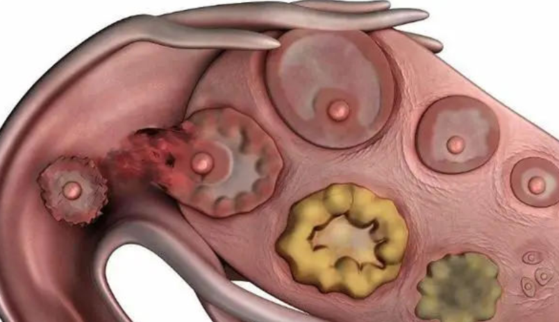 卵泡萎缩有什么症状？早期检查预防可避免不孕