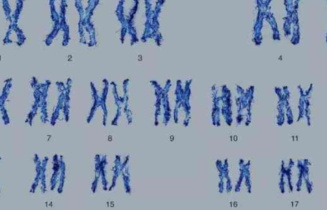 14号染色体异常会带来哪些影响，智力障碍、前列腺癌都是这导致的