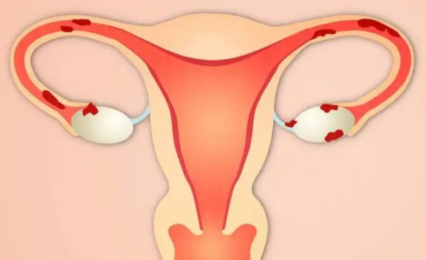 月经5天左卵巢数目12个，可能是多囊或药物引起