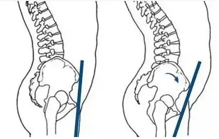 有哪些原因会造成骨盆前倾？骨盆前倾要怎么治疗？