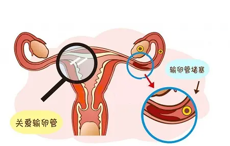 双侧输卵管积水，疏通后能怀孕吗？