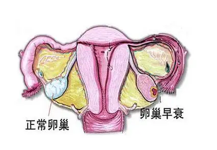 卵巢早衰严重程度影响患病女性的受孕几率