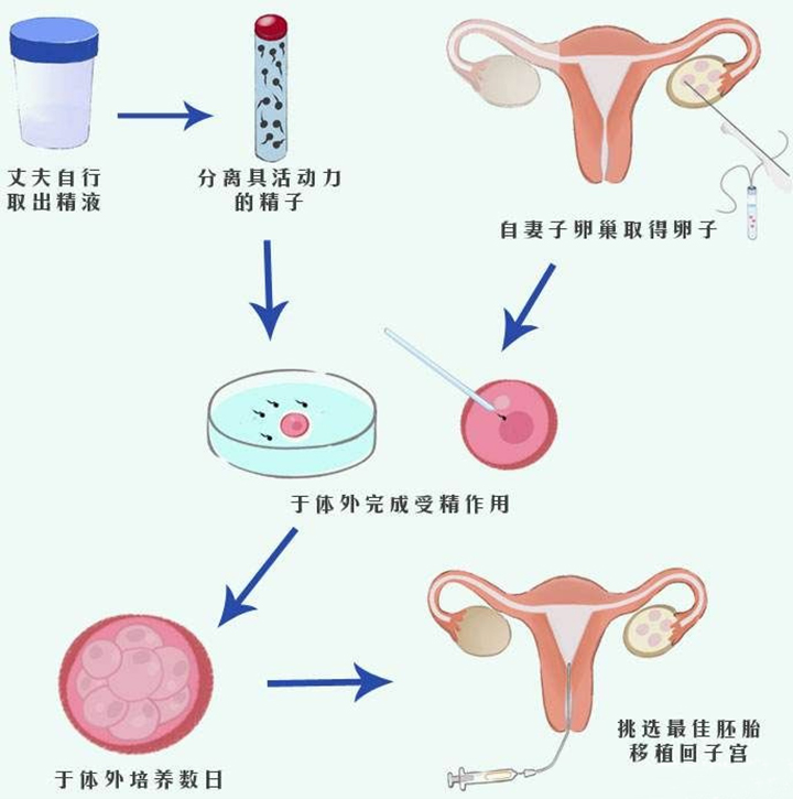 第三代试管婴儿具体流程