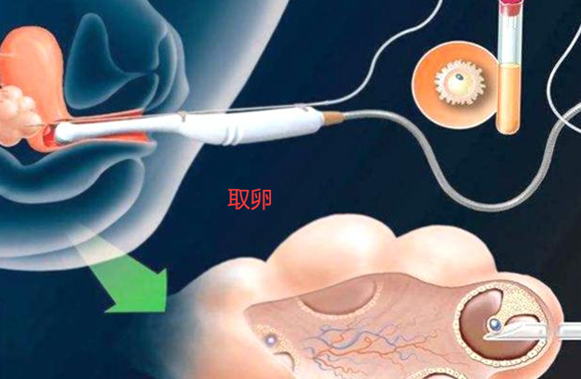 取卵能不能看出卵子质量,取卵一定要使用麻药吗