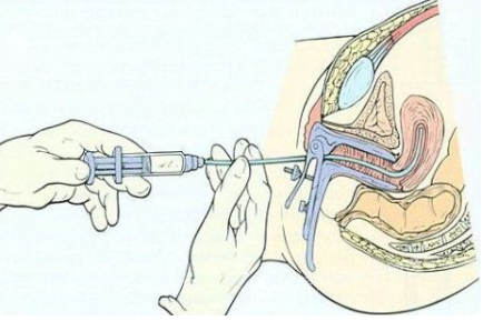 试管移植前内膜薄的女性做宫腔灌注有什么作用？