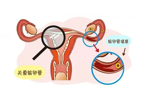 输卵管上举做试管成功率，过来人告诉你有多高