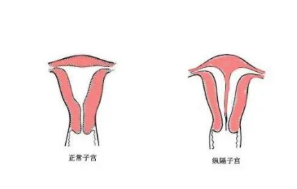 女性弓形子宫凹陷8mm怀孕后多久胎儿就安全了？