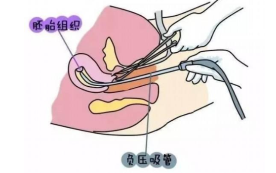 宫腔积液是人流没干净吗？