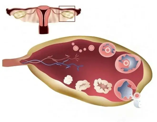卵巢破裂的治疗方式选择，手术效果更佳