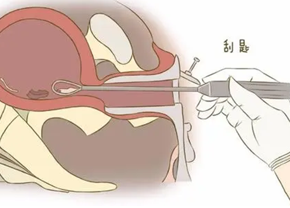 胎停一定要清宫吗,以下几种情况不需要清宫