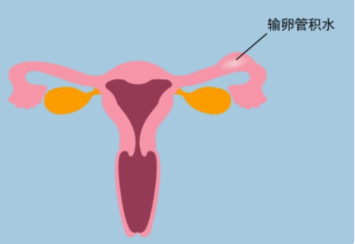 输卵管积水还会怀孕吗？