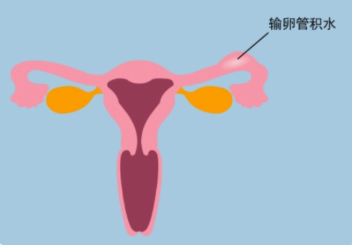 输卵管积水症状是什么？