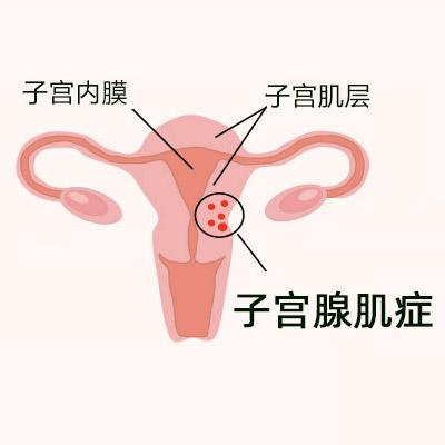 子宫腺肌症试管婴儿