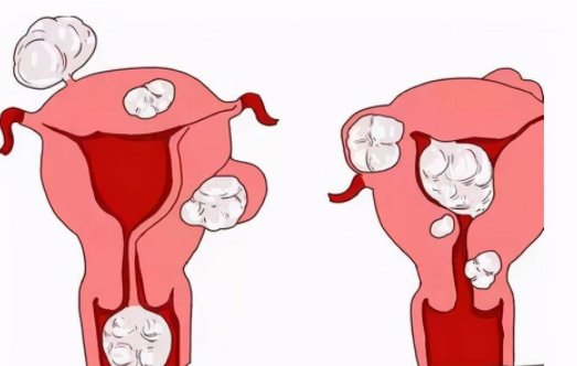 子宫腺肌症患者怀孕后的保胎工作十分重要，怎样保胎事半功倍