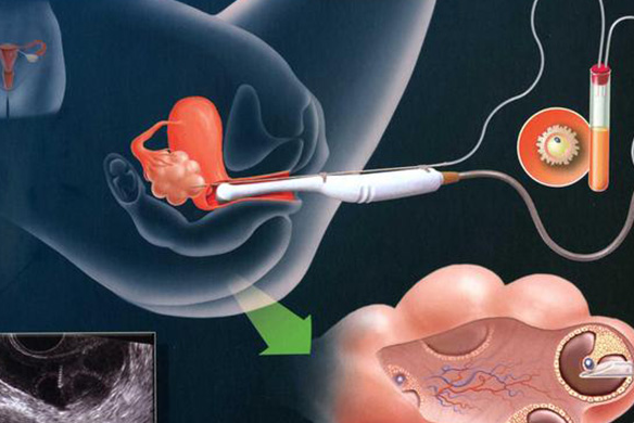 盆腔炎与试管婴儿：可行性与影响