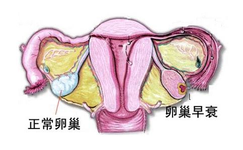 卵巢早衰的护理措施：如何应对卵巢早衰问题