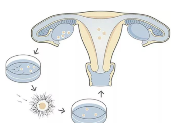 幼稚型子宫试管促排用长方案卵子质量好吗？