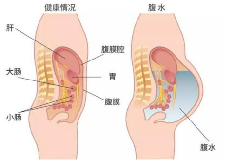 试管婴儿移植后，腹水应对全攻略