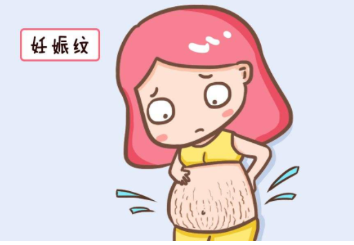 孕期如何预防妊娠纹？