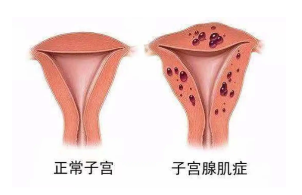 轻度子宫腺肌症试管备孕期间怎么调理身体？