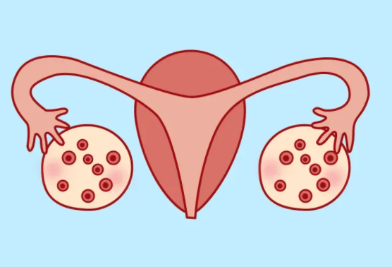 大部分人都不知道，为什么多囊卵巢怀孕容易胎停？