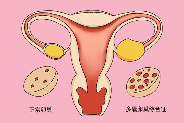 左侧卵巢囊肿试管可以连续促排吗？有什么注意事项吗？