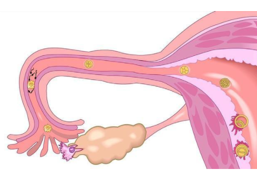 卵巢早衰不可逆，保养卵巢刻不容缓