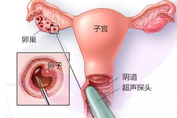 排卵障碍在辽宁做试管哪家医院成功率高？