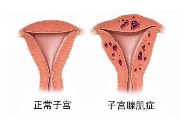 子宫腺肌症消融手术后要注意什么？